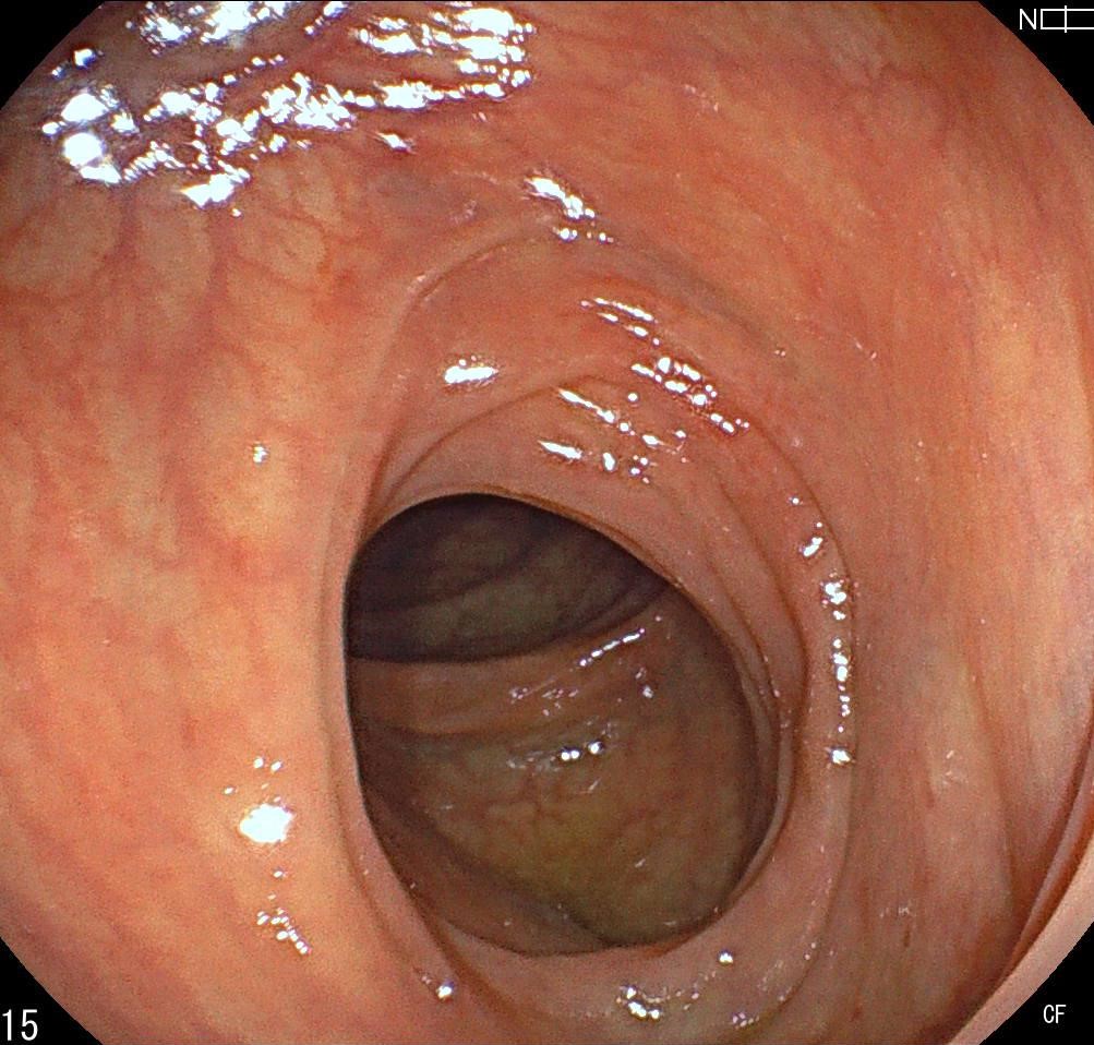 腸管スピロヘータの大腸カメラ画像【ほんじょう内科】